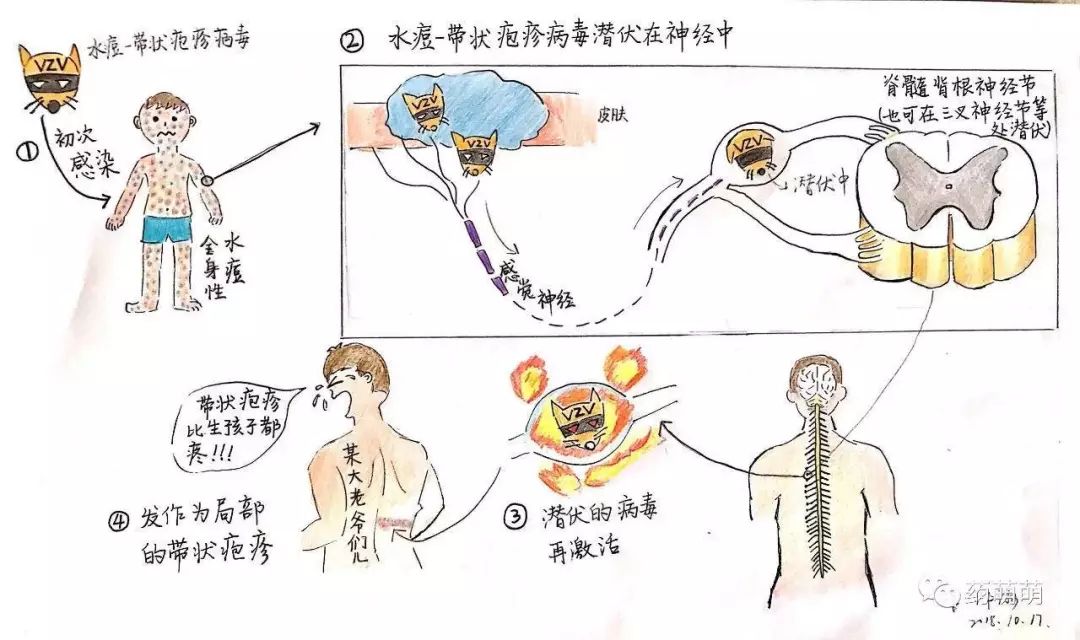 艾滋病患者得水痘会怎么样_艾滋病水痘是什么样子_艾滋病与水痘